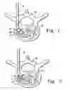 Fig. 02 - Enhanced visibility materials for implantation in hard tissue