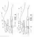 Fig. 07 - Surgical glove system