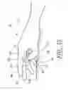 Fig. 08 - Surgical glove system