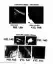 Fig. 19 - Medical device with coating that promotes endothelial cell adherence and differentiation