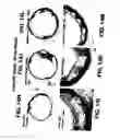 Fig. 20 - Medical device with coating that promotes endothelial cell adherence and differentiation