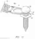 Fig. 04 - ORTHODONTIC CLOSED COIL SPRING ASSEMBLY AND METHOD OF USE THEREOF