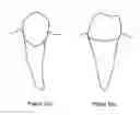 Fig. 02 - Dental appliance for deflecting gingival tissue