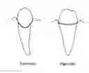 Fig. 03 - Dental appliance for deflecting gingival tissue