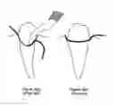 Fig. 04 - Dental appliance for deflecting gingival tissue
