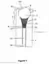 Fig. 02 - Sampling Device