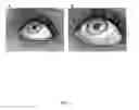 Fig. 02 - Method for treating primary and secondary forms of glaucoma