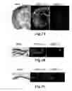 Fig. 02 - Novel compositions and methods for modulation of the acid-sensing ion channel (ASIC) for the treatment of anxiety and drug addiction