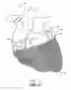 Fig. 02 - Cardiac harness having diagnostic sensors and method of use