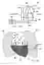 Fig. 33 - Cardiac harness having diagnostic sensors and method of use