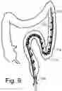 Fig. 06 - INFLATABLE GUIDE DEVICE