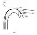 Fig. 02 - Magnetic field shape-adjustable medical device and method of using the same