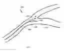 Fig. 03 - Magnetic field shape-adjustable medical device and method of using the same
