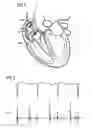 Fig. 02 - Method for analysing an intracardiac electrocardiogram and an electrophysiological system as well as a computer program product