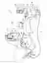 Fig. 02 - Mapping of complex fractionated atrial electrogram