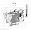 Fig. 05 - Mapping of complex fractionated atrial electrogram