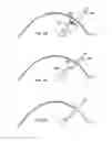 Fig. 23 - DEVICES AND METHODS FOR PERFORMING PROCEDURES ON A BREAST