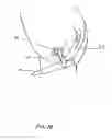 Fig. 19 - Disposable, leveraged mechanical prostate massager