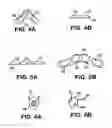 Fig. 03 - Orthotic device and segmented liner