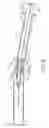 Fig. 07 - Safety syringe