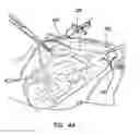Fig. 05 - INTRAFASCIAL CATHETER INTRODUCER SYSTEM AND METHOD OF DELIVERY OF POSTOPERATIVE ANESTHETICS
