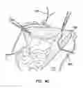 Fig. 07 - INTRAFASCIAL CATHETER INTRODUCER SYSTEM AND METHOD OF DELIVERY OF POSTOPERATIVE ANESTHETICS