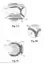Fig. 06 - Disposable sanitary napkin with pull-tab and method for the manufacture thereof