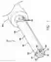 Fig. 02 - Method of removing biliary stones with coaxial catheter device