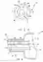 Fig. 04 - Method of removing biliary stones with coaxial catheter device