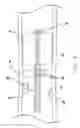 Fig. 08 - Method of removing biliary stones with coaxial catheter device