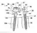 Fig. 01 - Articulating connecting member and anchor systems for spinal stabilization