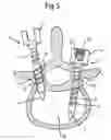 Fig. 03 - Bone anchoring device