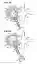 Fig. 10 - Apparatus and method for creating cavities in interior body regions