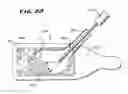Fig. 12 - Apparatus and method for creating cavities in interior body regions