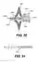 Fig. 44 - Method and apparatus for enhanced delivery of treatment device to the intervertebral disc annulus