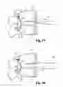 Fig. 13 - Method and apparatus for delivering an intervertebral disc implant