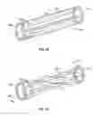 Fig. 09 - METHODS FOR RESTORING BLOOD FLOW WITHIN BLOCKED VASCULATURE