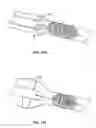 Fig. 20 - METHODS FOR RESTORING BLOOD FLOW WITHIN BLOCKED VASCULATURE
