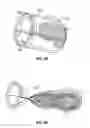 Fig. 11 - METHODS FOR RESTORING BLOOD FLOW WITHIN BLOCKED VASCULATURE