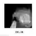 Fig. 03 - Peroral Transgastric Endoscopic Techniques