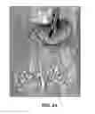 Fig. 08 - Peroral Transgastric Endoscopic Techniques