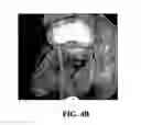 Fig. 09 - Peroral Transgastric Endoscopic Techniques