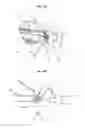 Fig. 07 - Lumen reduction methods and devices