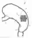 Fig. 02 - Intragastric device for treating obesity