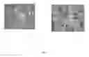 Fig. 07 - Temporarily stiffened mesh prostheses