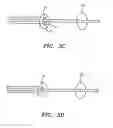 Fig. 04 - Devices and methods for preventing distal embolization using flow reversal in arteries having collateral blood flow