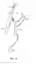 Fig. 10 - Devices and methods for preventing distal embolization using flow reversal in arteries having collateral blood flow