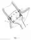 Fig. 04 - Devices and methods for endolumenal gastrointestinal bypass