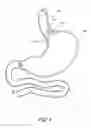 Fig. 05 - Devices and methods for endolumenal gastrointestinal bypass