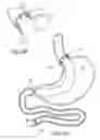 Fig. 07 - Devices and methods for endolumenal gastrointestinal bypass